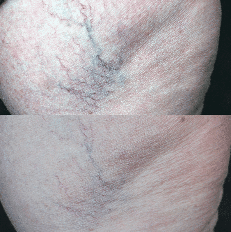 Unsightly thread veins? We have the answer. Vascular lesion treatment