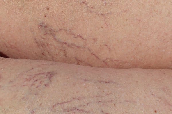 Intense pulsed light for vascular lesions