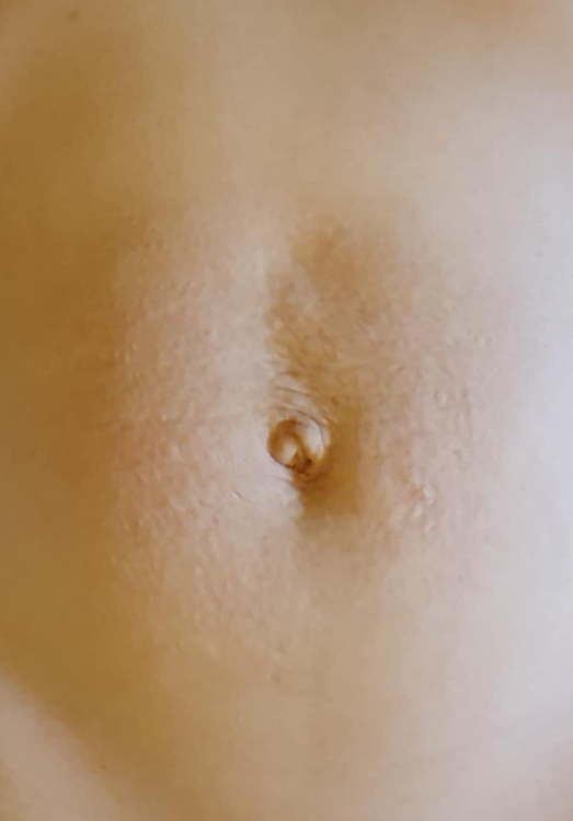 before and after collagen lift for stretch marks waxed by lex
