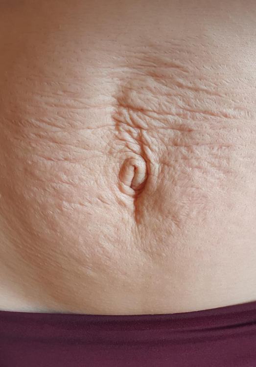 before and after collagen lift for stretch marks waxed by lex