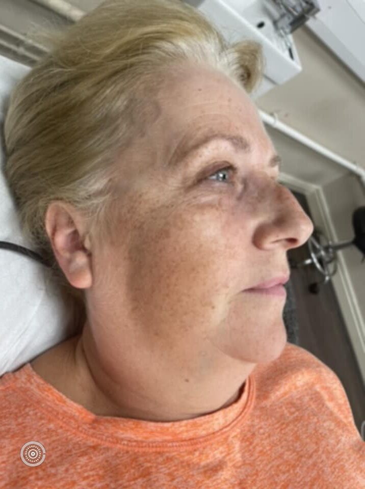 before and after SkinBase collagen lift all about the face
