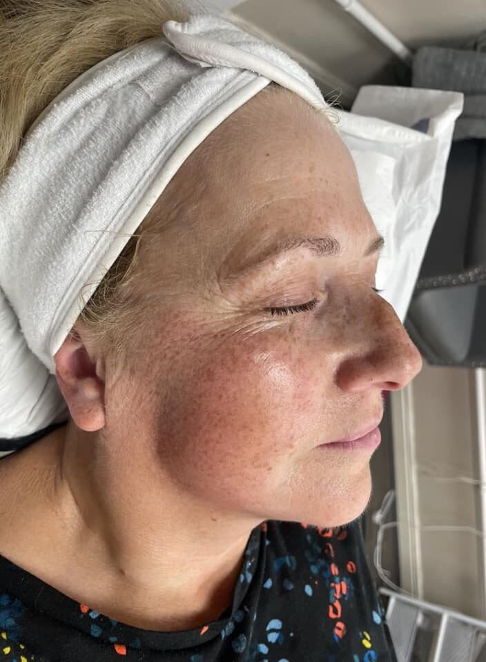 before and after SkinBase collagen lift all about the face