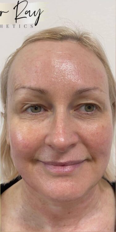 before and after collagen lift amber ray aesthetics