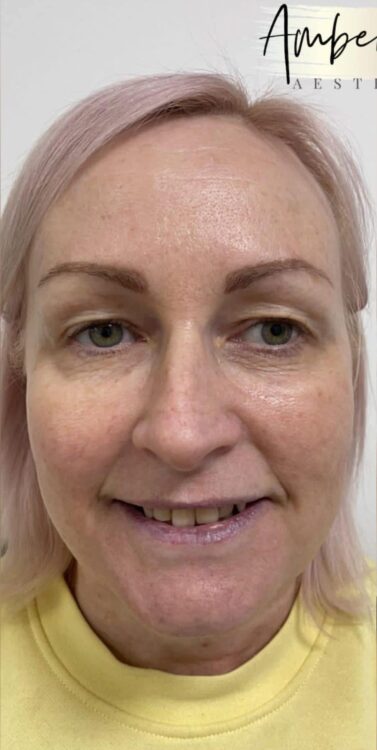 before and after collagen lift amber ray aesthetics
