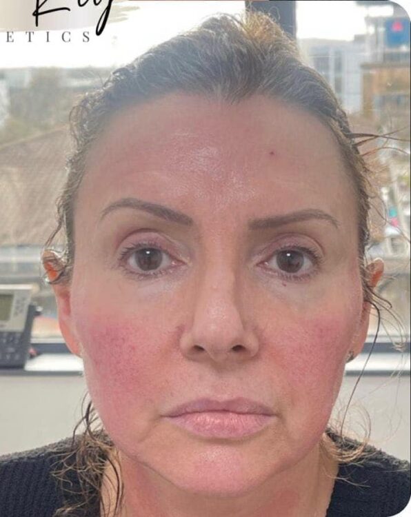 before and after collagen lift amber ray aesthetics