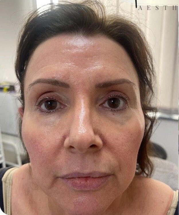 before and after collagen lift amber ray aesthetics