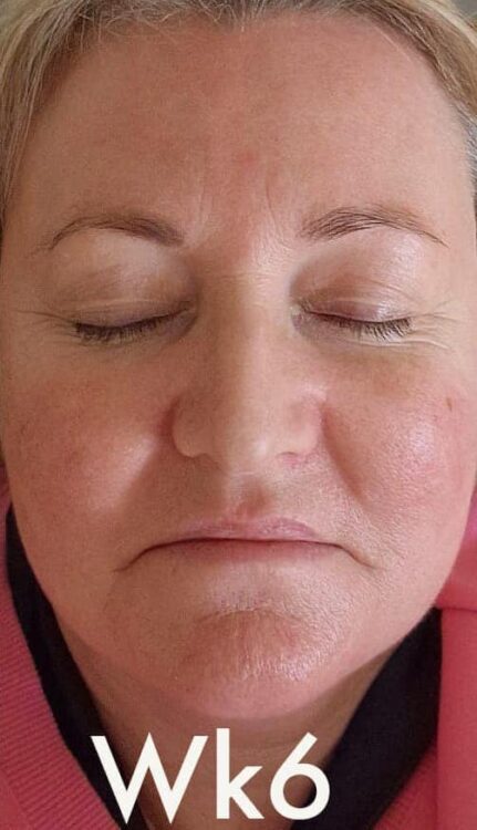 before and after collagen lift Amy Marsden beauty