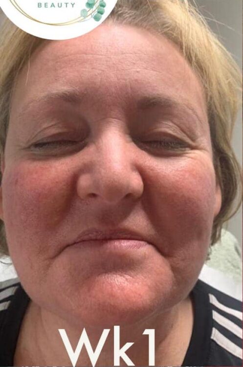 before and after collagen lift Amy Marsden beauty
