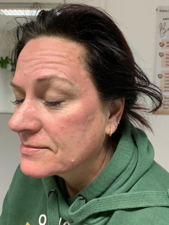 before and after collagen lift Amy Marsden beauty