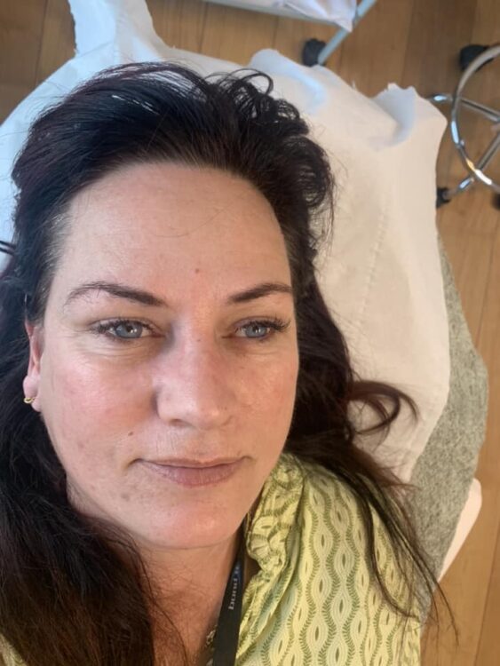 before and after collagen lift Amy Marsden beauty