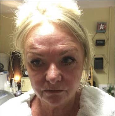 before and after collagen lift a nu u beauty