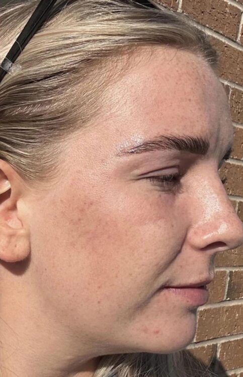 before and after microdermabrasion A Nu U Beauty & Brows