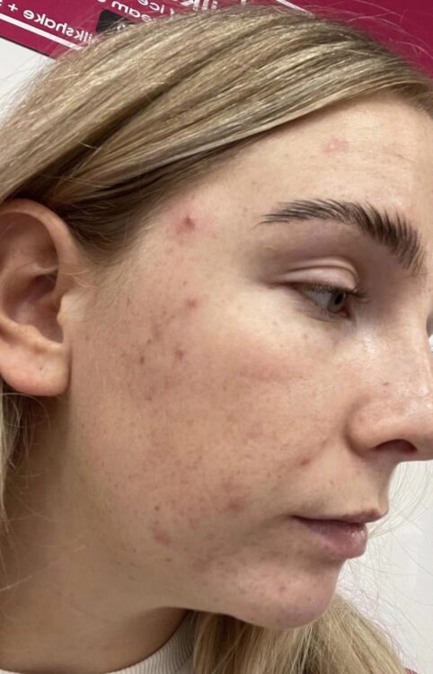 before and after microdermabrasion A Nu U Beauty & Brows