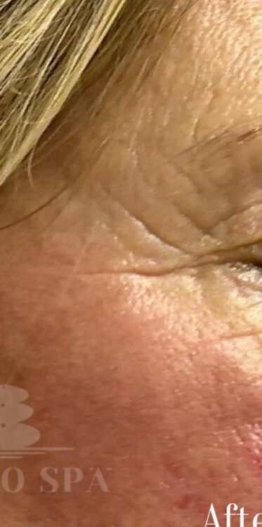 before and after collagen lift ultimate ayano spa
