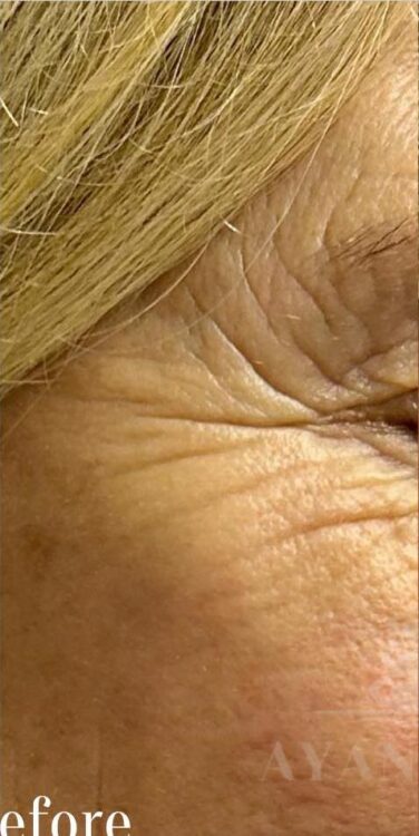 before and after collagen lift ultimate ayano spa