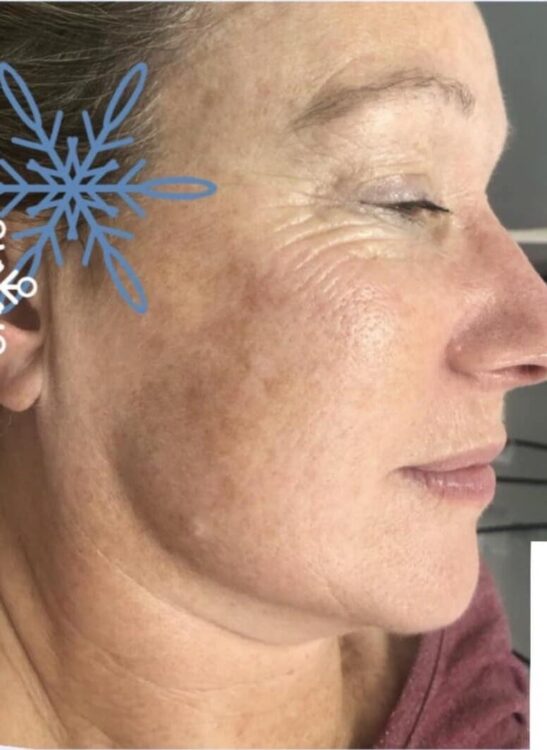 before and after collagen lift beau chic beauty and aesthetics