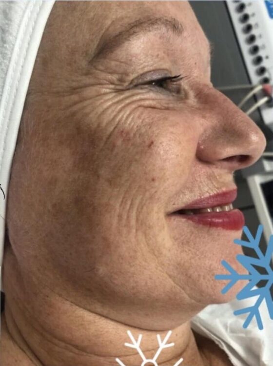 before and after collagen lift beau chic beauty and aesthetics