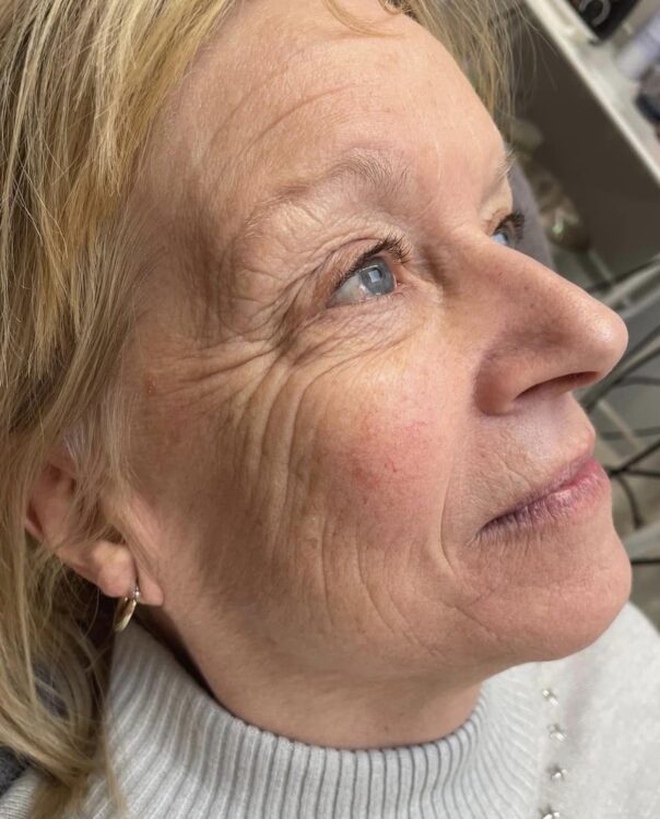 before and after collagen lift beaute