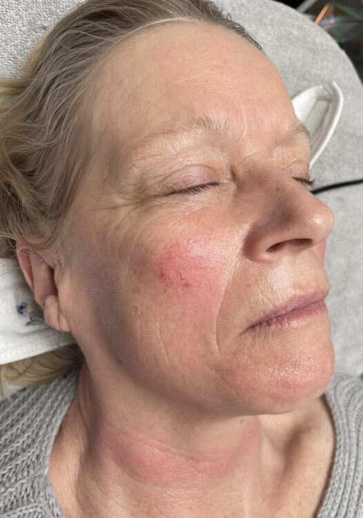 before and after collagen lift beaute