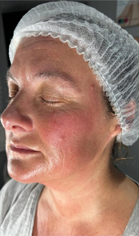 before and after collagen lift beatylicious by Claudia