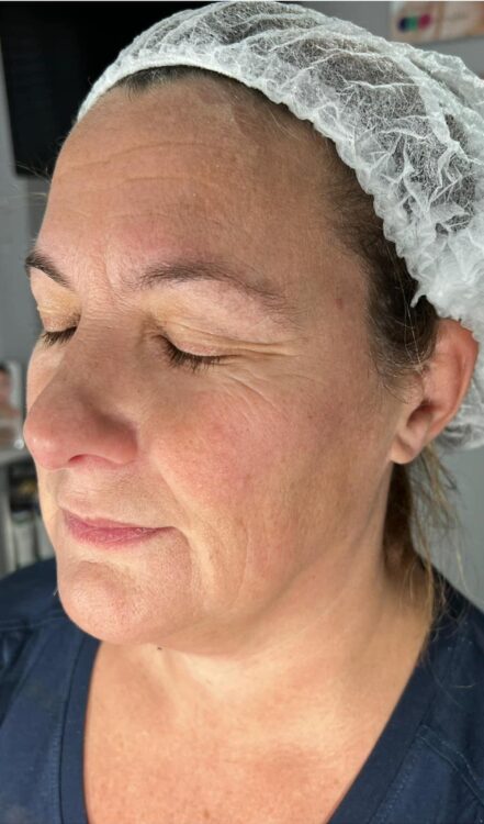 before and after collagen lift beatylicious by Claudia