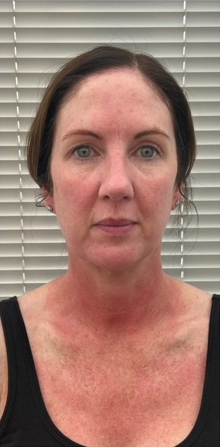 before and after collagen lift beauty by eve