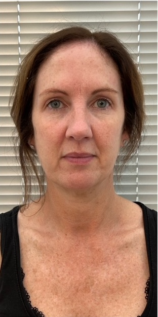 before and after collagen lift beauty by eve