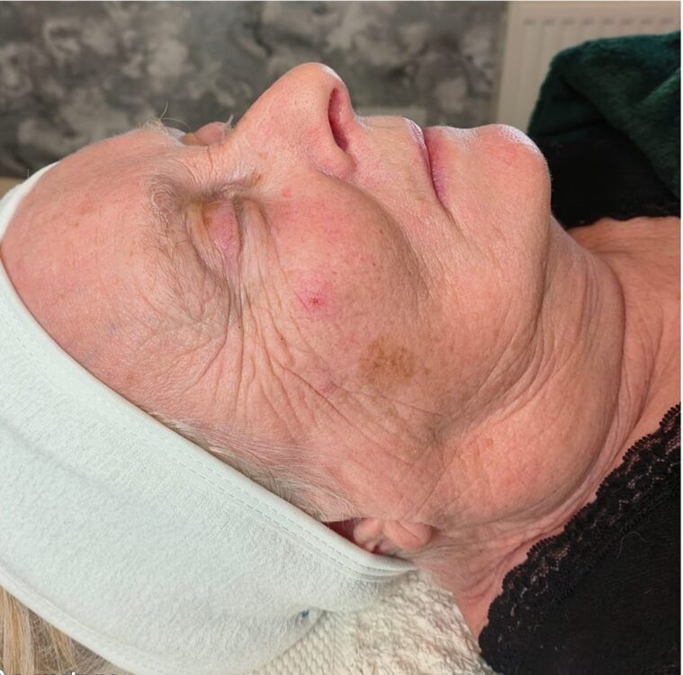 before and after collagen lift beauty by Jessica
