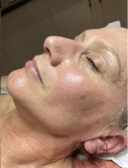 before and after collagen lift beauty by Joanne smedley