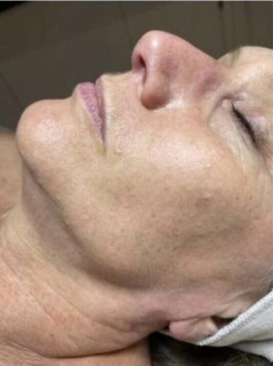 before and after collagen lift beauty by Joanne smedley