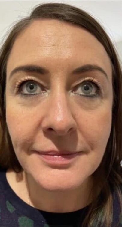 before and after Collagen Lift beauty by Joanne smedley