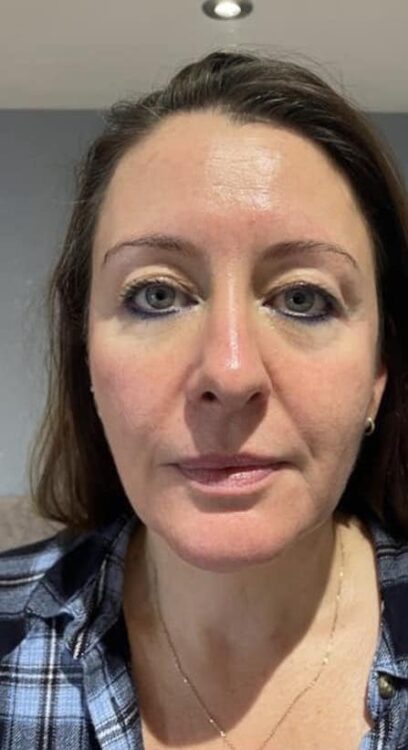 before and after Collagen Lift beauty by Joanne smedley