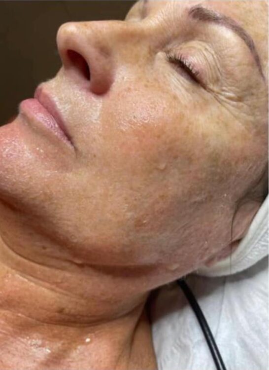 before and after collagen lift beauty by Joanne smedley