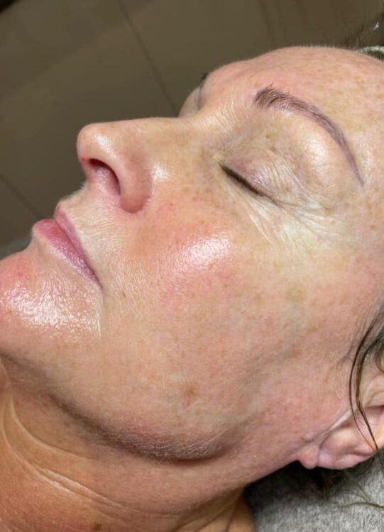 before and after collagen lift beauty by Joanne smedley