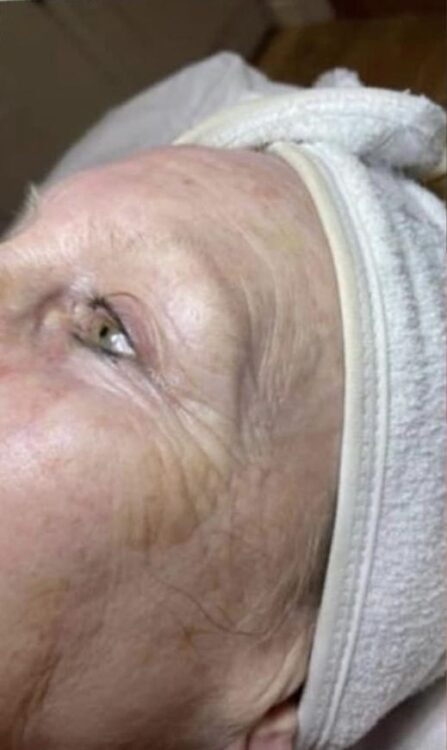 before and after collagen lift beauty by Joanne smedley