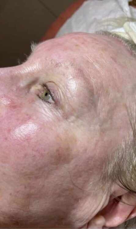 before and after collagen lift beauty by Joanne smedley