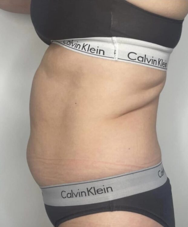 before and after collagen lift beauty by Lisa brown