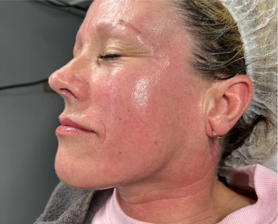 before and after collagen lift beautylicious by Claudia