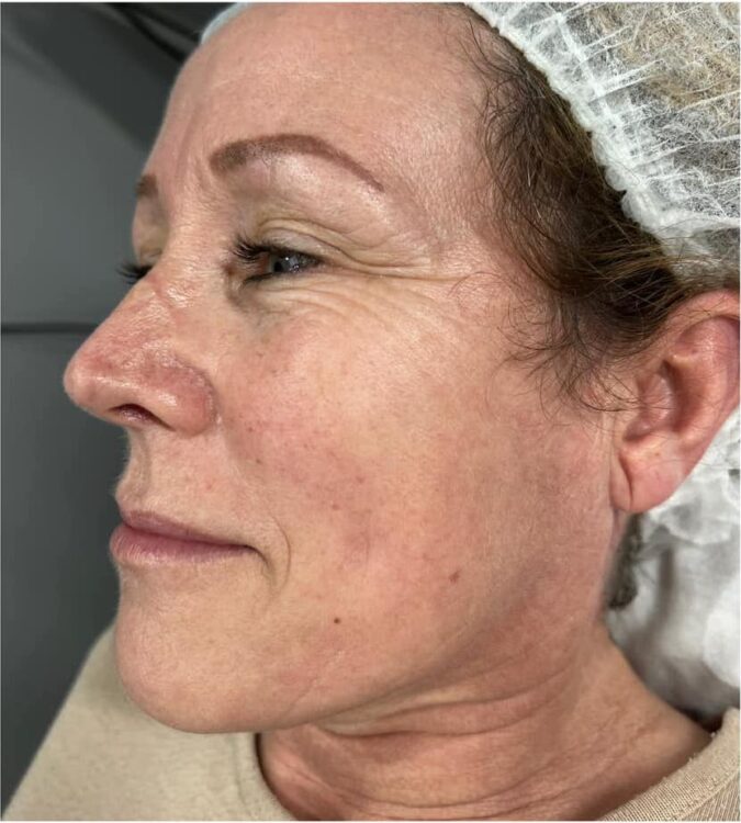 before and after collagen lift beautylicious by Claudia