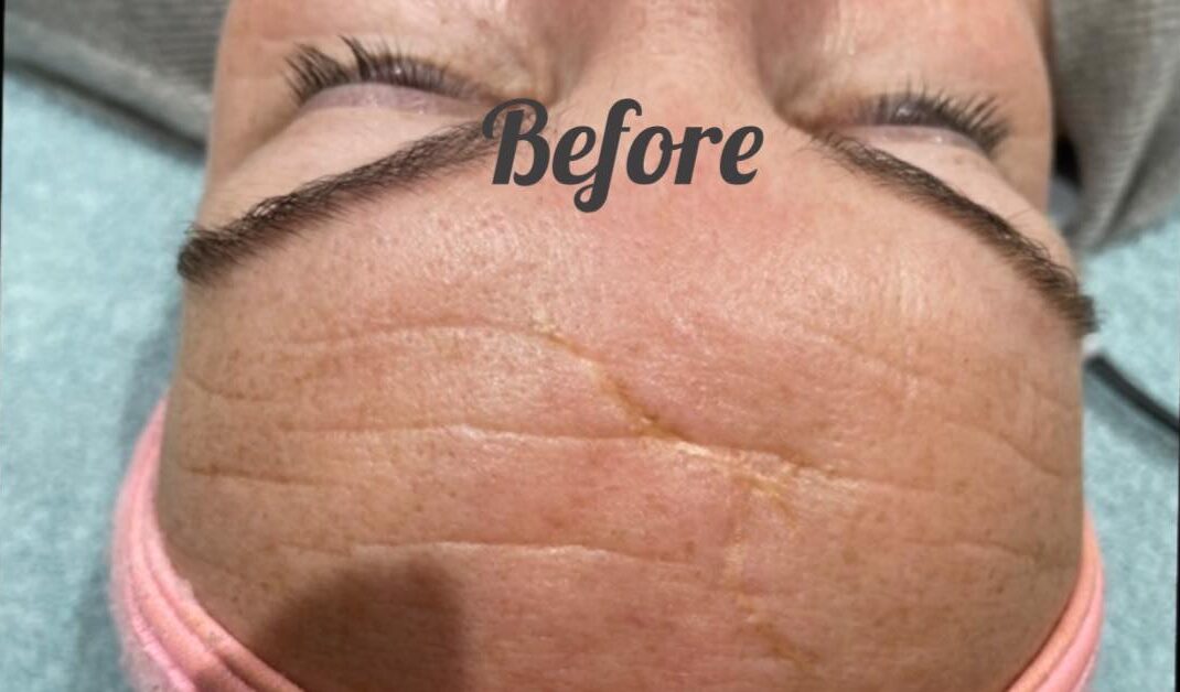 before and after collagen lift beauty on the green