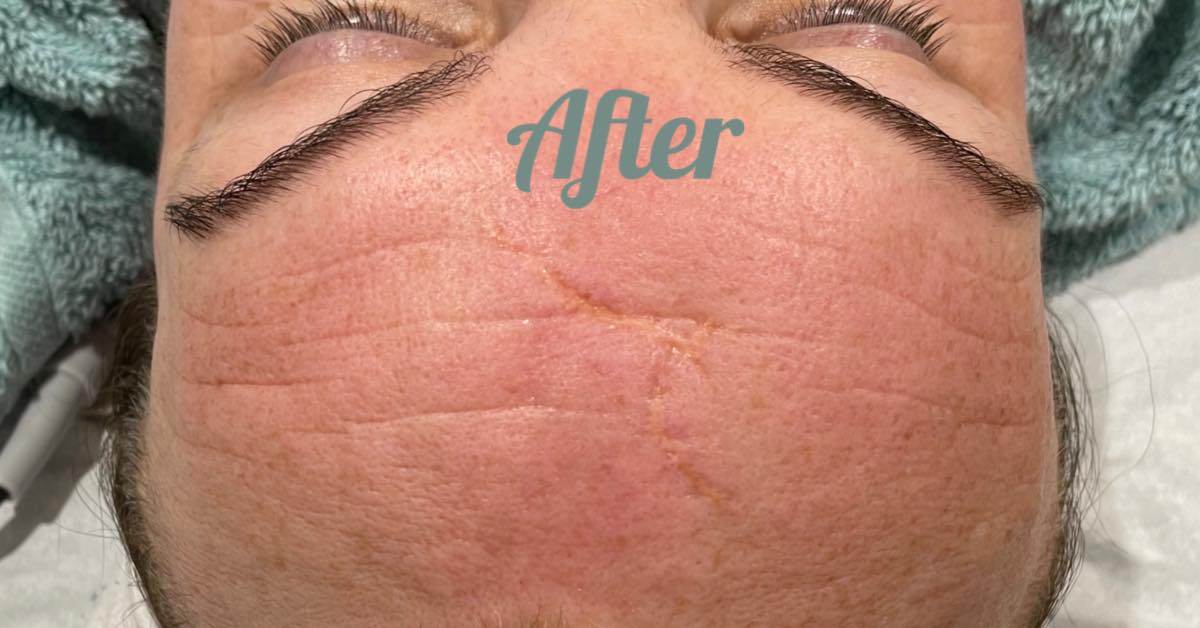 before and after collagen lift beauty on the green