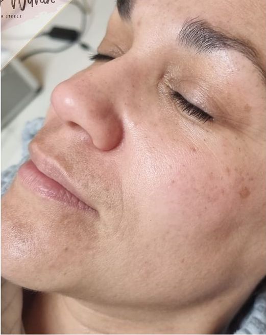 before and after microdermabrasion beauty within by Laura