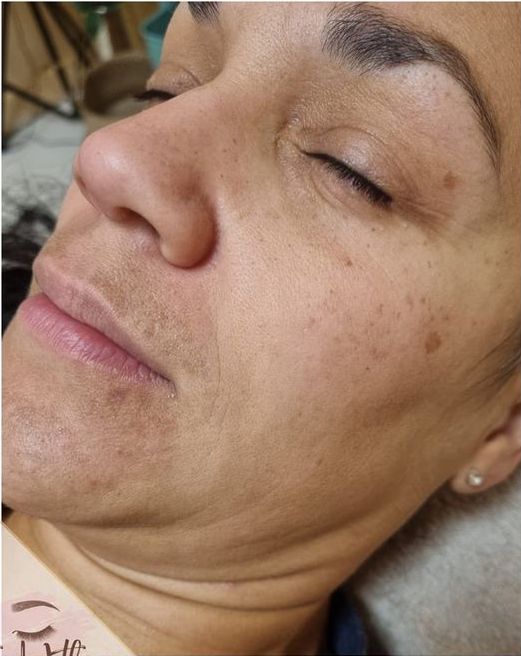 before and after microdermabrasion beauty within by Laura