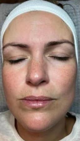 before and after collagen lift ultimate becky's beauty and holistics