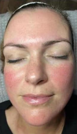 before and after collagen lift ultimate becky's beauty and holistics