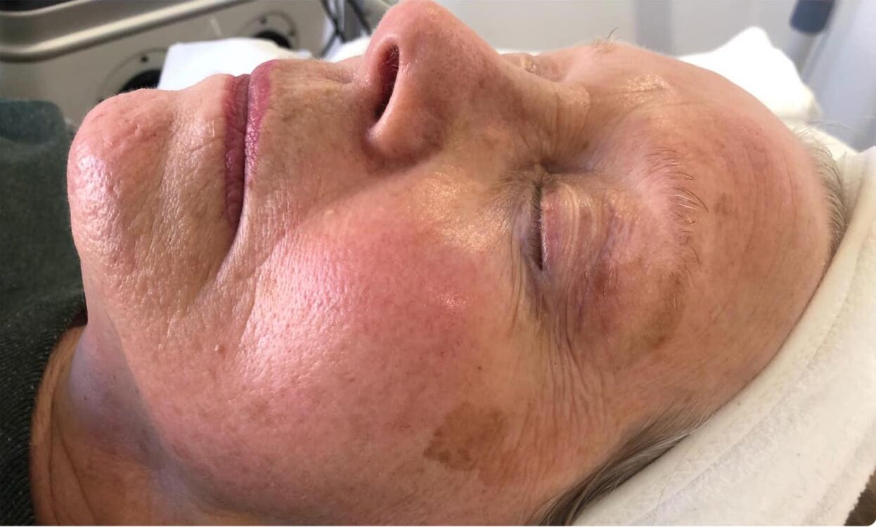 before and after collagen lift Bela academy