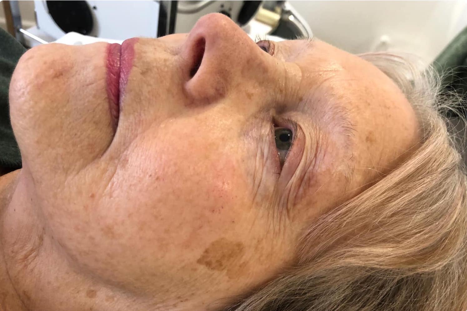 before and after collagen lift Bela academy