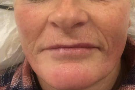 before and after collagen lift Bela academy