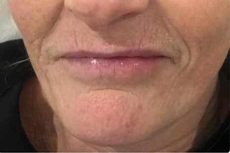before and after collagen lift Bela academy