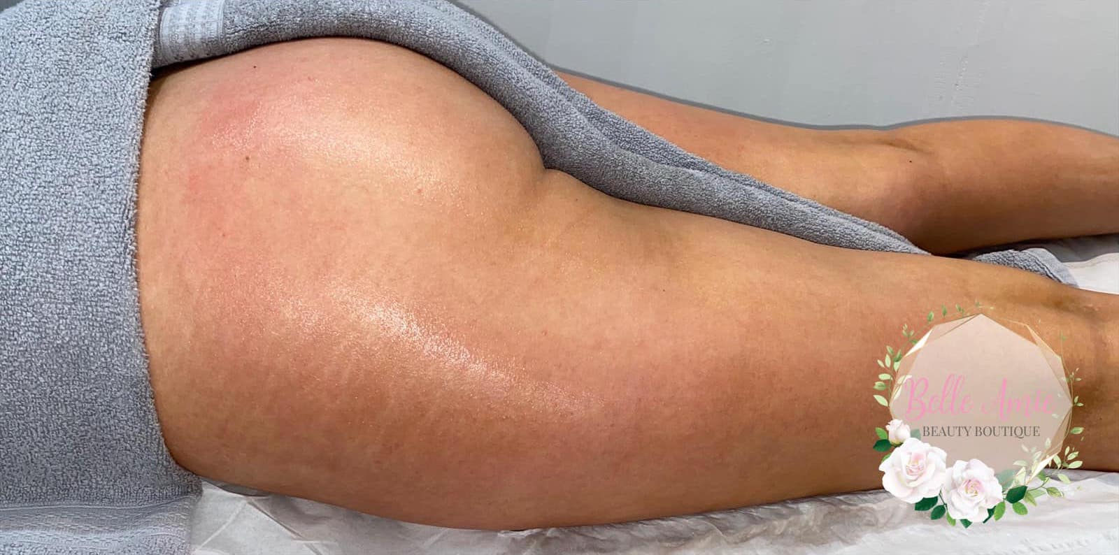 before and after collagen lift belle amie beauty boutique